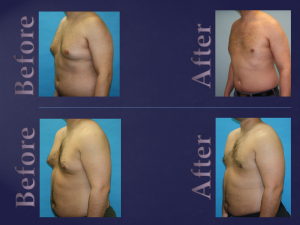 Gynecomastia Before and After by Dr. Emmanuel Asare, male breast reduction specialist